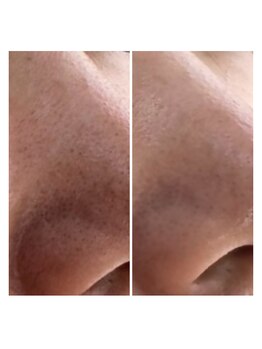 サロナプア(Salona Pua)/ハイドラ毛穴洗浄1回の施術