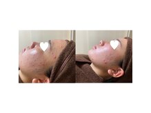 エステモ 札幌店(ESTEMO)/★３回の施術★ビフォーアフター