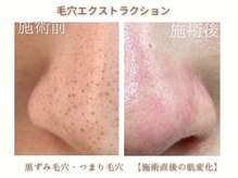 ミリ(MiLi)の雰囲気（毛穴エクストラクションで鼻の黒ずみの悩みを解消！）