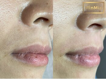 ルプラス(LUPLUS)/意外と見られている口周り!