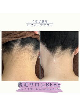 ベベ(Bebe)/うなじほっそり美人脱毛♪