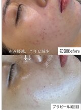 サロン ド クマ(salon de KUMA)/肌質改善　