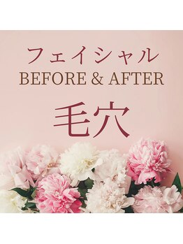 ゼロ(ZERO)/フェイシャル☆毛穴洗浄