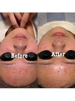 プレシャス(Precious)/ブラックフェイシャル/赤ら顔