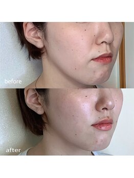 ナビレラ(navillera)の写真/【面長・食いしばり改善】骨格から整える本格小顔矯正☆筋肉の強張りをほぐして顔下半身をきゅっと短縮!
