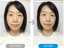 ワト(WATO)/■小顔施術（before→after)