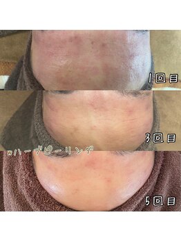 プレジール(Plaisir)/wハーブピーリング