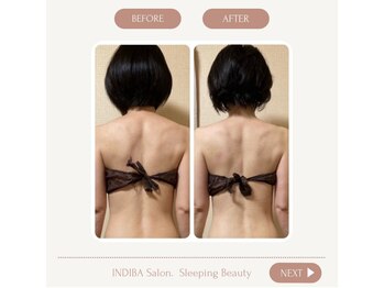 スリーピングビューティー(Sleeping Beauty)/インディバ　肩の盛り上がり改善