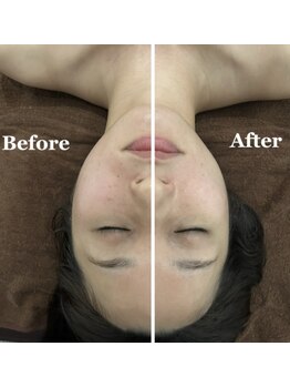 エミアンジュ(Emi Ange)/インディバフェイシャル