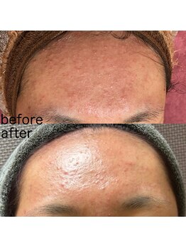 レクレア/エクソソーム原液