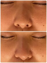 シャンス(Chance)/ハイドロ毛穴洗浄　施術例