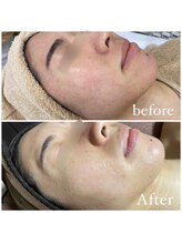 肌質改善専門【Salon da Mahina】毛穴ケア/ニキビケア/ハーブピーリング/ニキビ/毛穴/ハーブピーリング