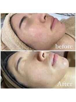 肌質改善専門【Salon da Mahina】毛穴ケア/ニキビケア/ハーブピーリング/ニキビ/毛穴/ハーブピーリング