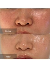 マインエム(mine.m)/くすみ/シミ/毛穴/肌質改善