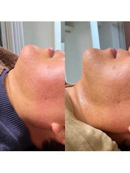 ピュアリー(purly)の写真/エステ歴15年！凄腕オーナーが導く、レモンボトルで速攻小顔爆誕体験♪顎下のもたつき、二重アゴ速攻ケア