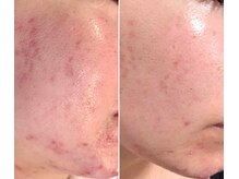 シルク ド ココ(Silk de Coco)/プラズマジェット