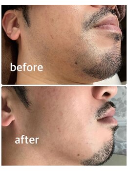 アネモネ(anemone)/ヒゲスタイル進化