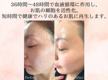 美肌研究所 東京新宿支店/凹凸のお肌、数回での変化◎