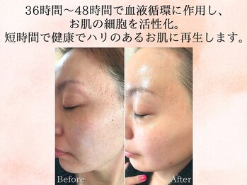 美肌研究所 東京新宿支店/凹凸のお肌、数回での変化◎