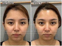 エミマス ボーテ(Emimas Beaute’)/３０代　小顔矯正＆毛穴洗浄