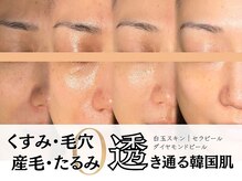 【毛穴０の韓国肌エステ】印象グッと変わる！渡韓なしの白玉肌