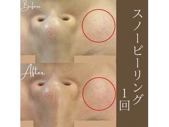 サロンドペシェ(salon de peche)/徹底美白乳酸ピーリング