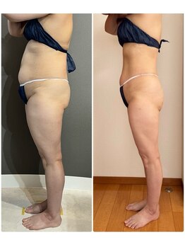 エミニー バイ エルズ(Eminy by L★s)/50代 セルゼロ全身 27回