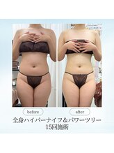 エスプレッソ(espresso,)/【全身痩身15回】くびれゲット！