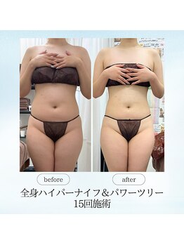 エスプレッソ(espresso,)/【全身痩身15回】くびれゲット!