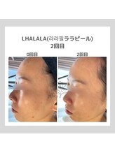 韓国肌管理室pom.haneul【ポムハヌル】LDM/インモード/ララピール/プラピール福岡天神/韓国肌管理室