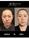 ヘルディン(heldin +555)の写真/【美容業界が注目!】痛みなし・ダウンタイムなしで叶える、美容業界注目の最新リフトケア☆