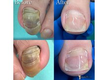 巻き爪補正店 町田店/～変形爪～