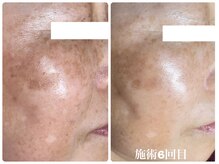 フォーチューン/シミの改善