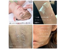 【感動の肌変化！】リベルハーブピーリング☆体験価格ございます