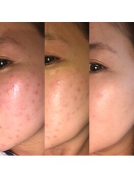 ザ シー タイムレスビューティ(THE SHE)/30代お客様症例写真