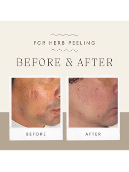 サロンアン(Salon an)/肌質改善にFCRハーブピーリング