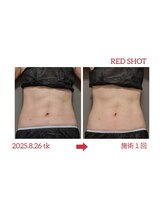 サロン ド 花歩 松山本店/痩身だけじゃない！くびれ作りも