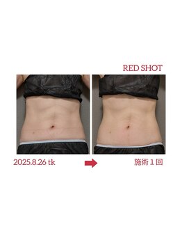 サロン ド 花歩 松山本店/痩身だけじゃない！くびれ作りも