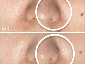 アンリミット 鹿児島天文館店(Une limit)/毛穴レス肌へ