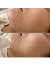 プリュムアイ フェイシャルホーム(prume eye.facial home)/ニキビケア