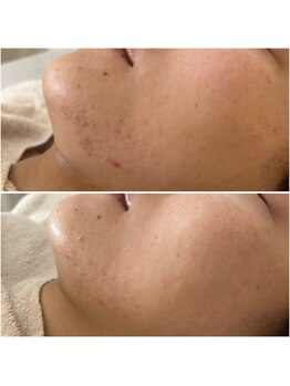 プリュムアイ フェイシャルホーム(prume eye.facial home)/ニキビケア