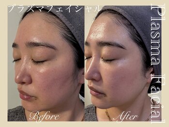 ミリュール(Millule)/リフトアップ&トーンアップ