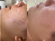 グレイティア(gratia)/光フォト&バクテリウムピール