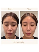 ハロネ(Halone’)/リッチハーブピーリング