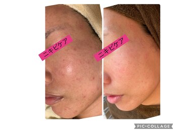 ポアレ(POARE)/お手入れ3回目ハーブピーリング