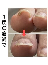 自爪ケアサロン 横浜/フット巻き爪矯正コース