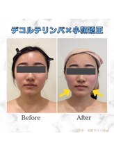 ミエル(Miel)/Before After