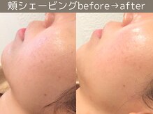 ももとゆでたまご/頬シェービング/ 新宿　渋谷２駅