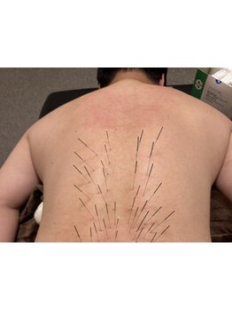 鍼灸施術を受けたい