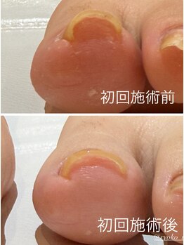 緒々 ワンプラス(one+)/巻き爪初回施術前→施術後